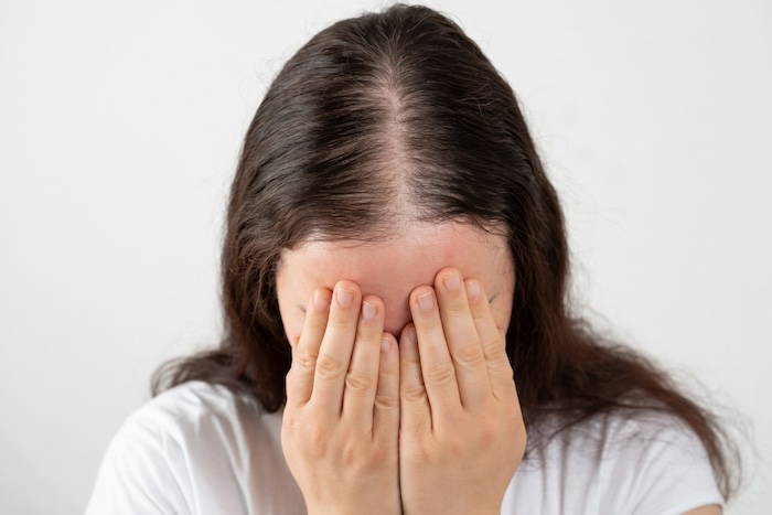 Nữ hói đầu