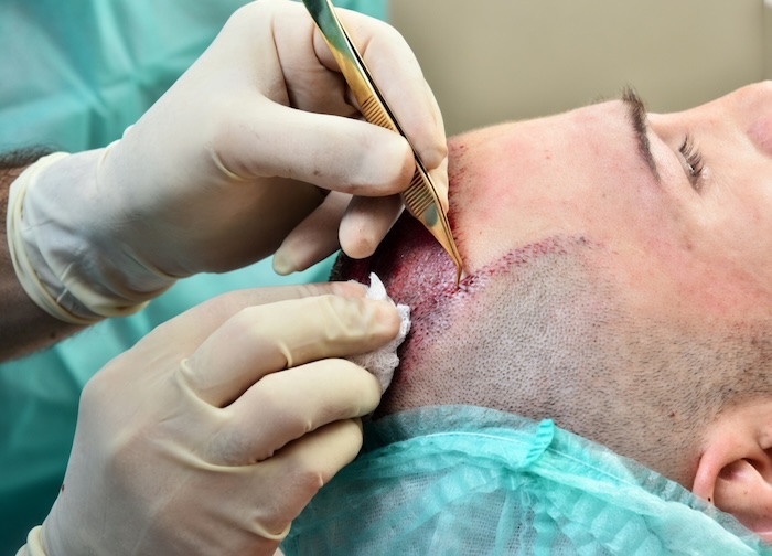 Phẫu thuật cấy tóc điều trị hói