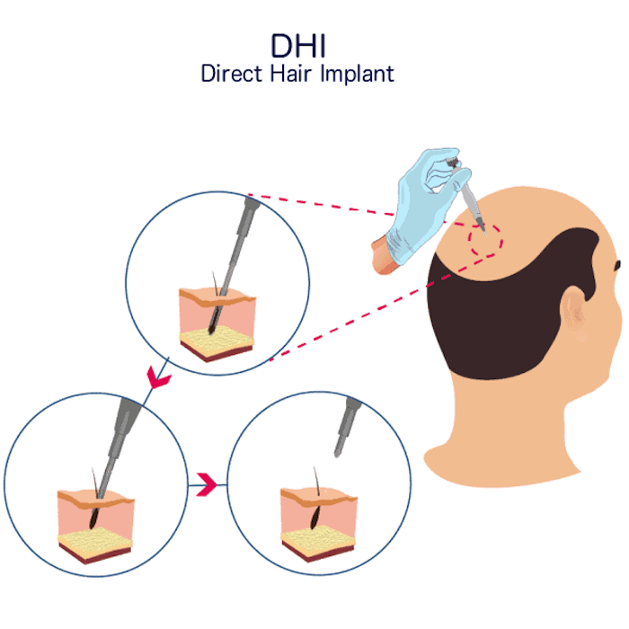 Phương pháp cấy tóc dhi