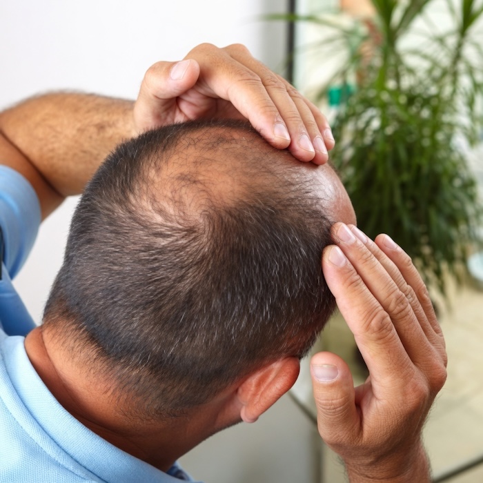 Thuốc điều trị rụng tóc hói đầu Thuốc điều trị rụng tóc hói đầu