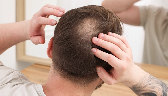 Thuốc mọc tóc cho người bị hói Thuốc mọc tóc cho người bị hói