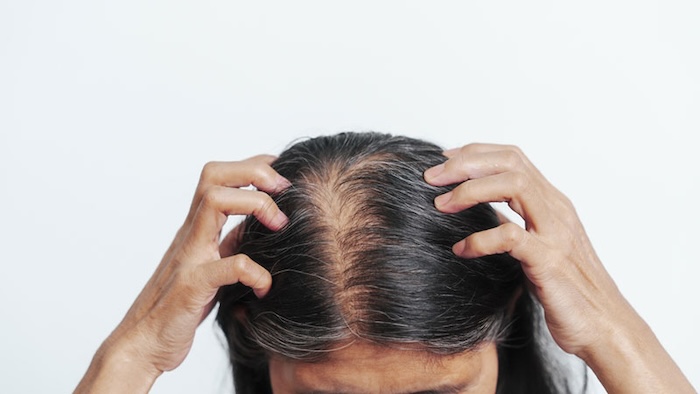 Thuốc trị hói đầu cho nữ Thuốc trị hói đầu cho nữ