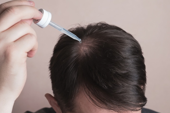 Thuốc trị hói đầu nữ