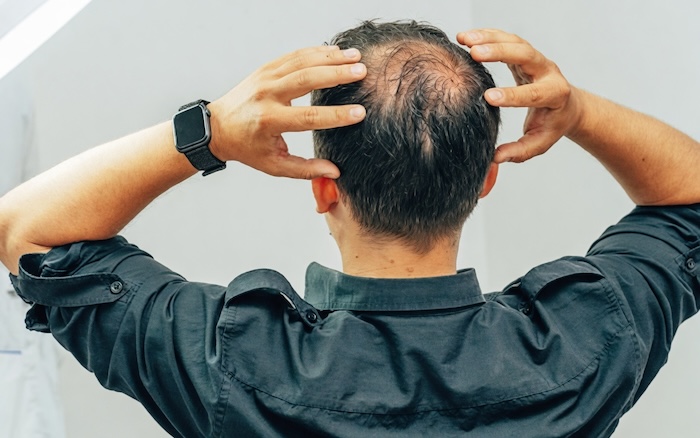 Tính cách người hói đầu