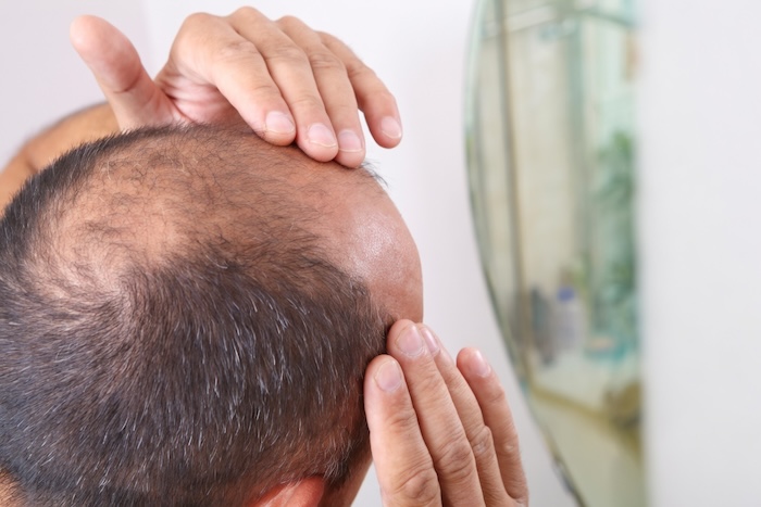 Tóc bị hói