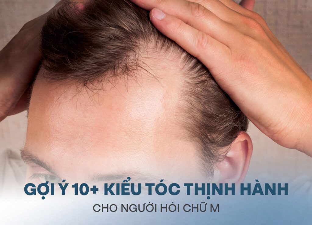 Tóc hói chữ m để kiểu gì