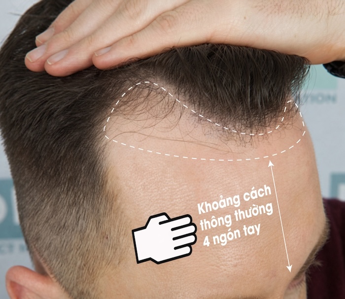 Tóc hói m Tóc hói m
