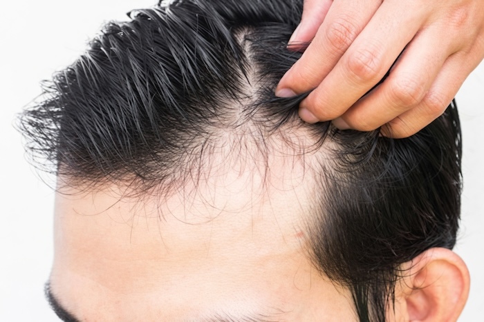 Tóc hói ở trán Tóc hói ở trán