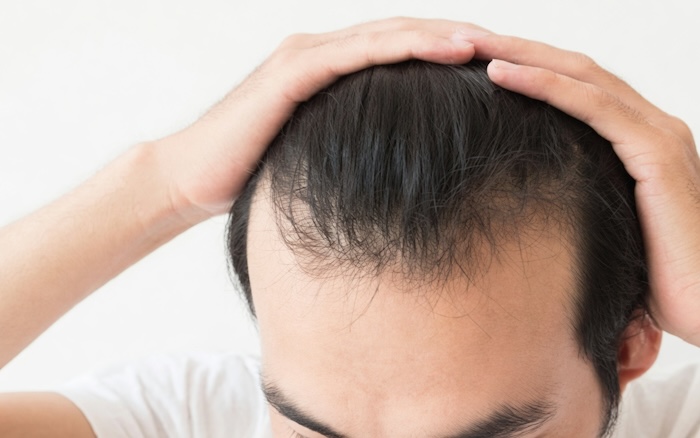 Tóc nam hói chữ m