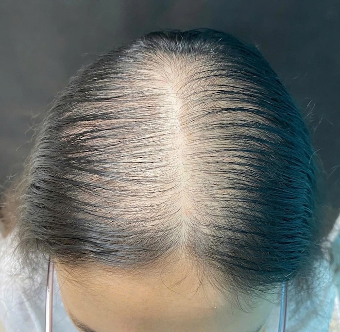 Tóc rụng hói đầu