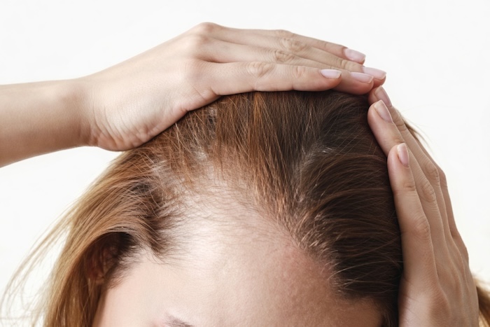 Tóc thưa và hói đầu Tóc thưa và hói đầu