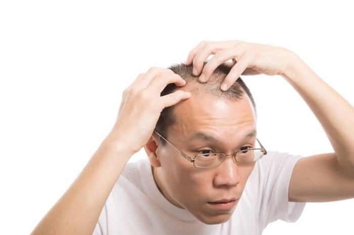 Trán cao hói chữ m