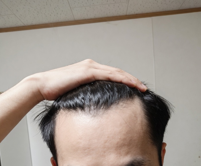 Trán chữ m có bị hói không