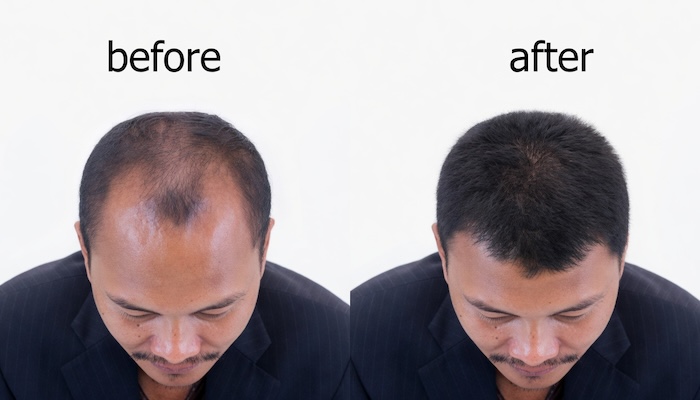 Trị hói đầu nam