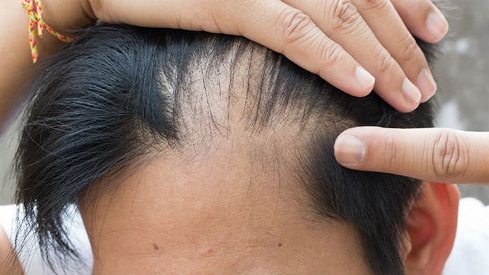 Trị rụng tóc hói đầu