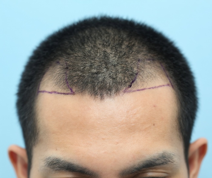 Trồng tóc cho nam