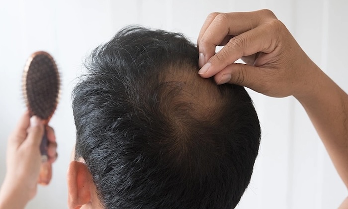 Trung tâm cấy tóc black hair