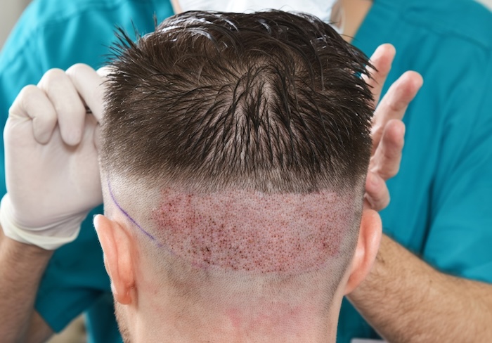 Viện cấy tóc hà nội
