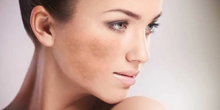 Bị nám 1 bên mặt Bị nám 1 bên mặt