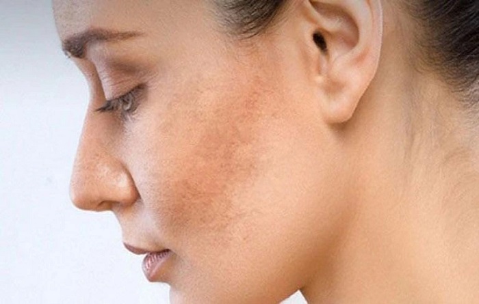 Bị nám da ăn gì Bị nám da ăn gì