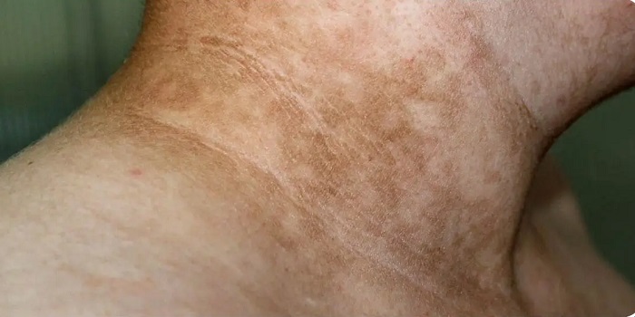 Bị nám da ở cổ