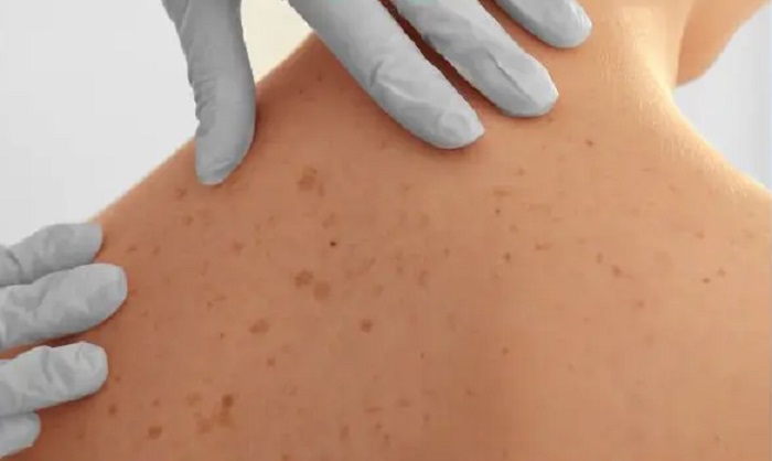 Bị nám da ở lưng
