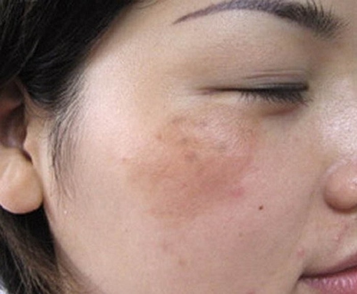 Biểu hiện của da sắp bị nám