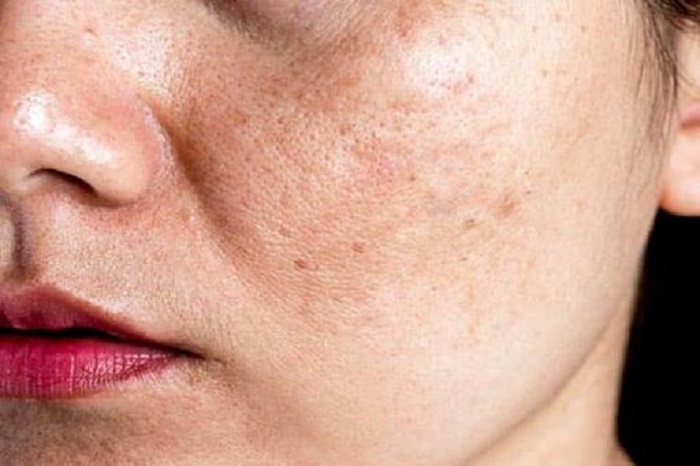 Cách trị nám cho da mỏng