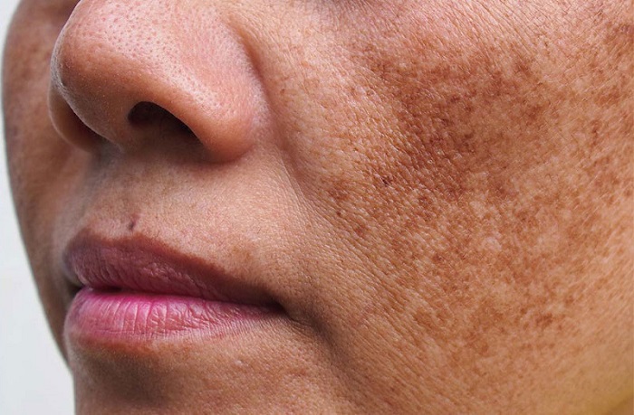 Cách trị nám da dị ứng