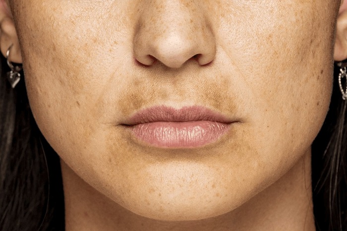 Cách trị nám râu hiệu quả