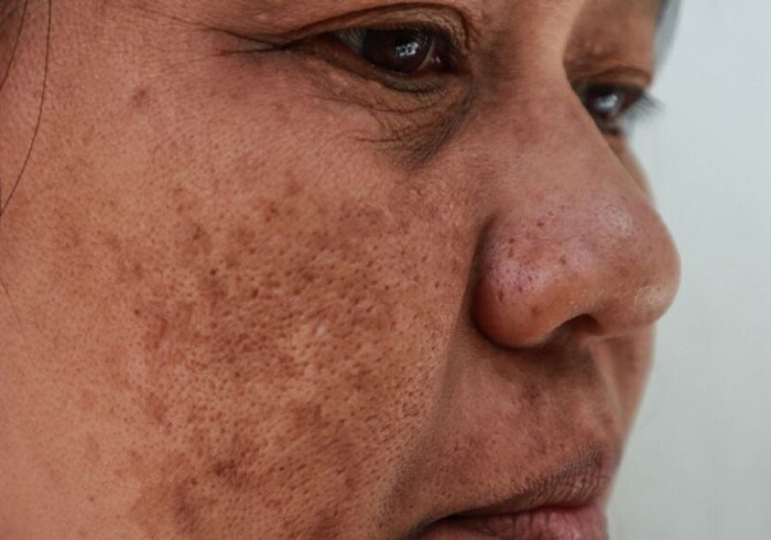 Điều trị nám hcm