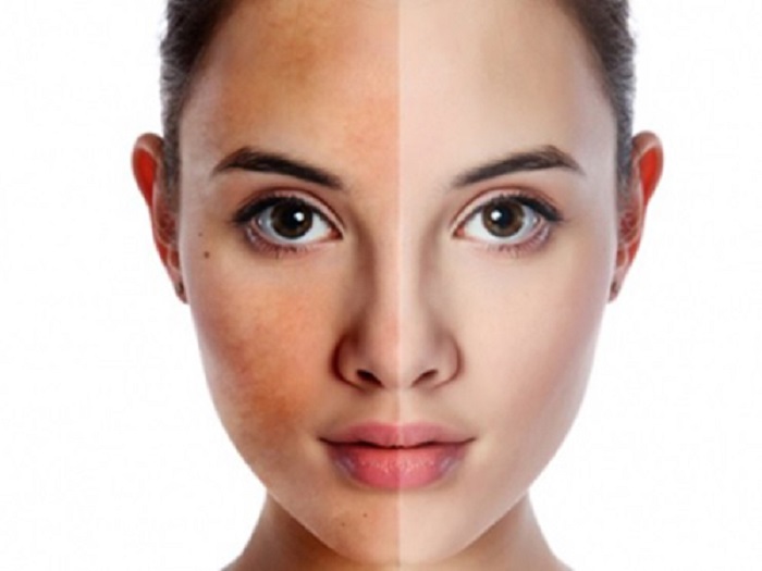 Điều trị nám trẻ hóa da