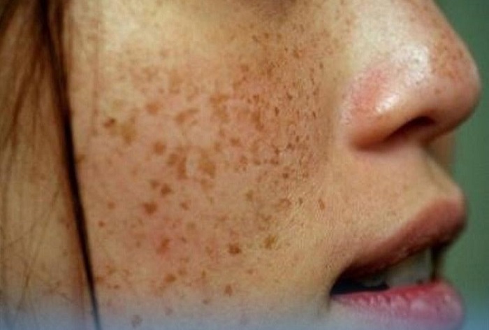 Giải pháp cho làn da nám sạm