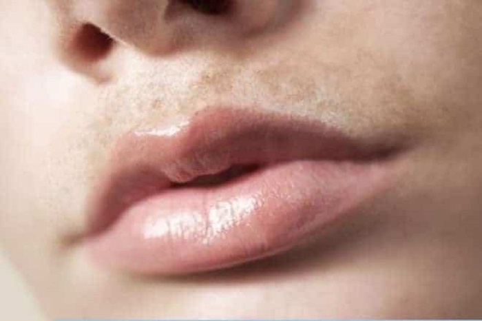 Mẹo trị nám râu