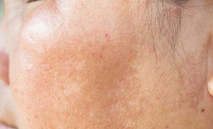 Nám da bẩm sinh Nám da bẩm sinh