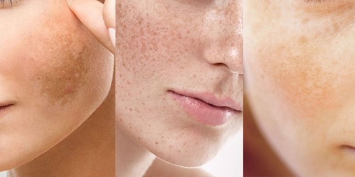 Nám da bệnh học