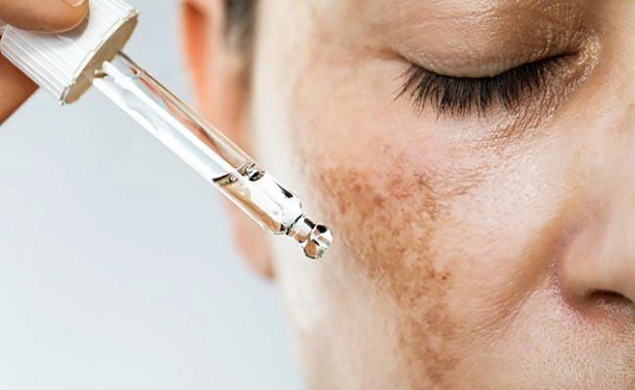 Trị nám bằng axit