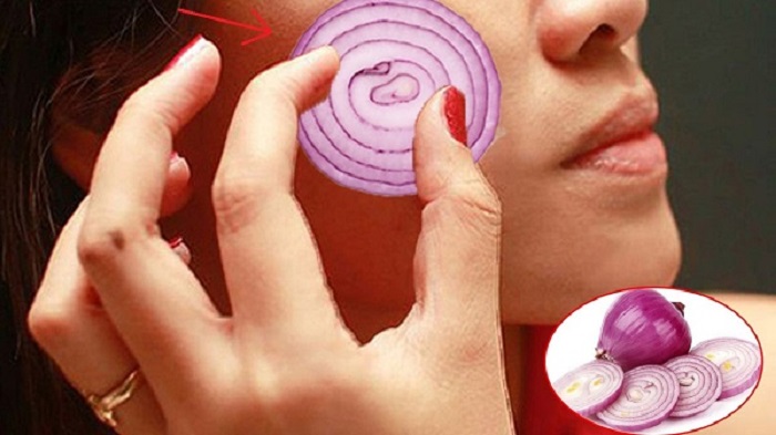 Trị nám bằng hành tím