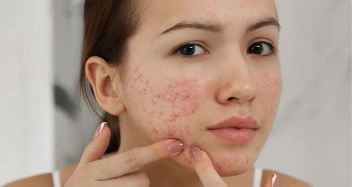 Trị thâm nám sau mụn