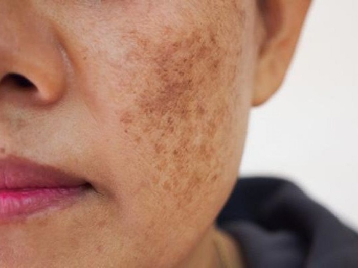 Bộ trị nám trắng da