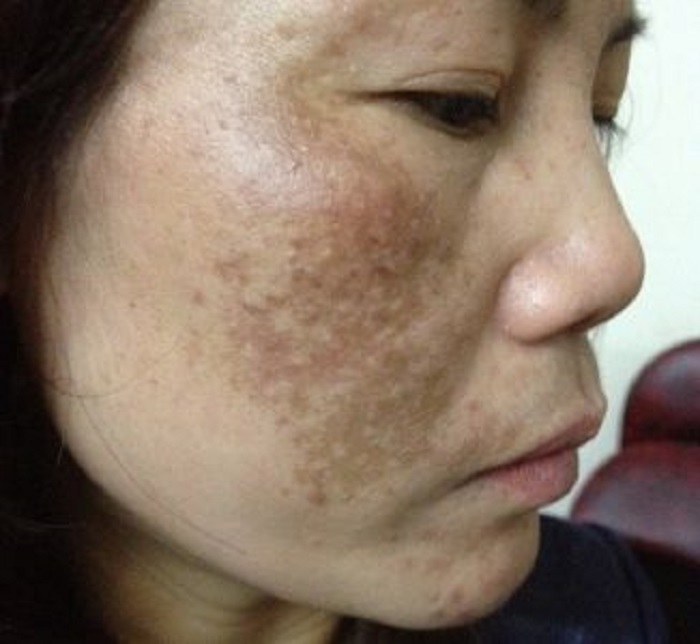 Cách làm mờ nám chân sâu