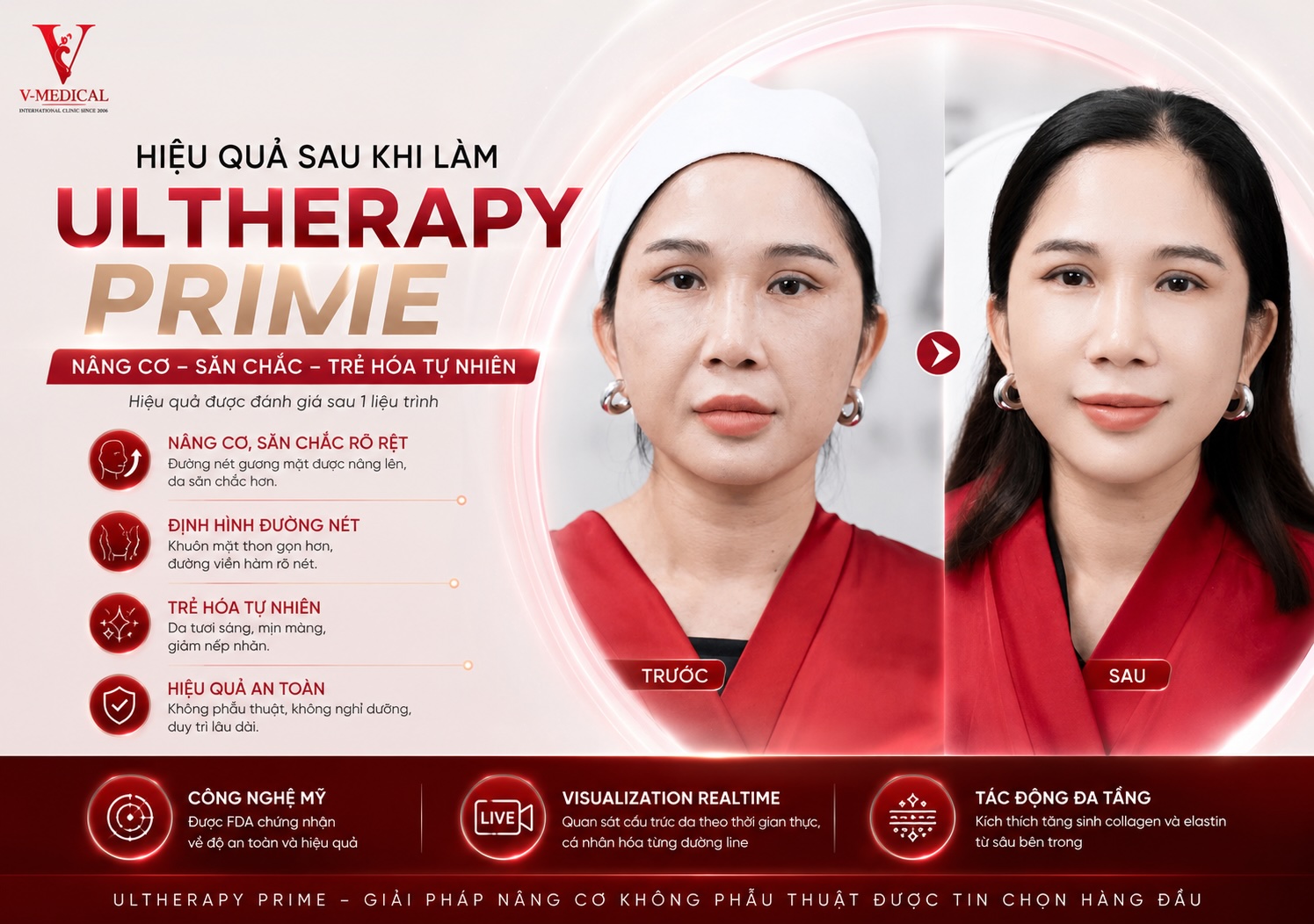 Công nghệ ultherapy prime Công nghệ ultherapy prime