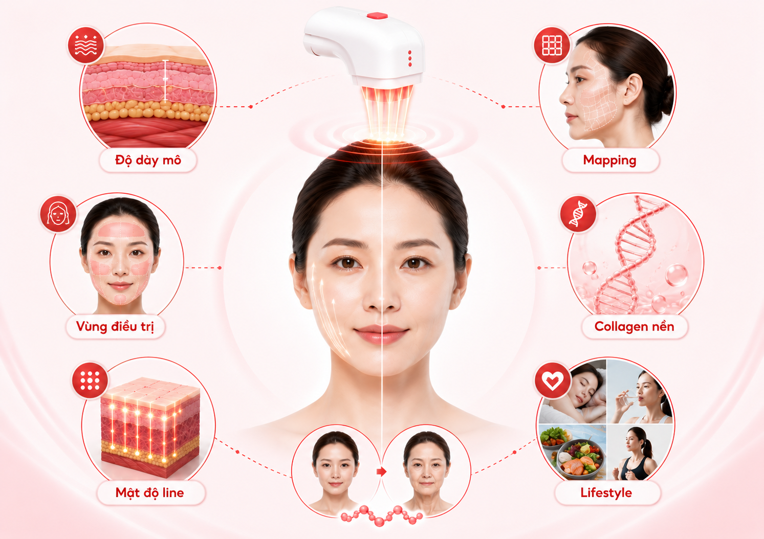 Hifu ultherapy là gì