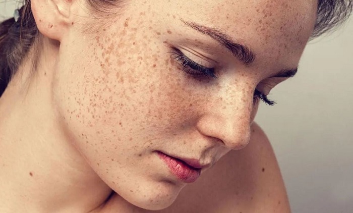 Làm thế nào để mờ vết nám Làm thế nào để mờ vết nám