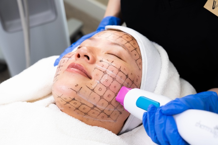 Làm thermage bao lâu thì đẹp