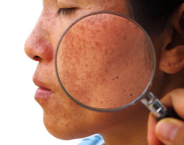 Mặt nạ nghệ tươi trị nám