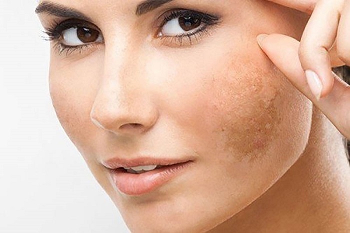 Mặt nạ trị nám bằng bột sắn dây