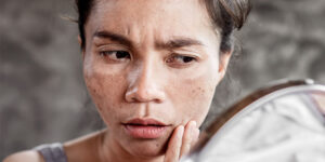 Nám chân kim Nám chân kim