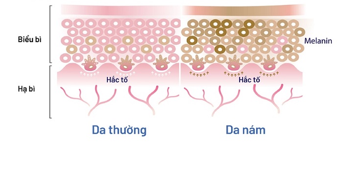 Nguyên nhân hình thành nám nội tiết