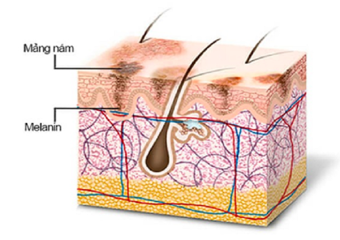 Nguyên nhân và cơ chế hình thành nám